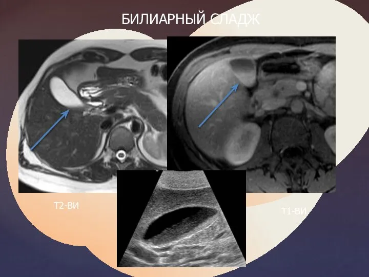 Т2-ВИ Т1-ВИ БИЛИАРНЫЙ СЛАДЖ