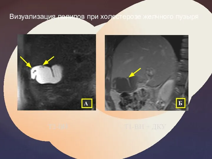 А Б Визуализация полипов при холестерозе желчного пузыря Т2-ВИ Т1-ВИ + ДКУ