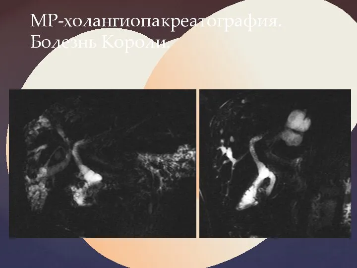 МР-холангиопакреатография. Болезнь Короли.