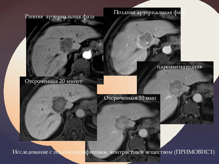 Ранняя артериальная фаза Поздняя артериальная фаза паренхиматозная Отсроченная 10 мин Отсроченная