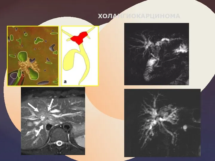 ХОЛАНГИОКАРЦИНОМА