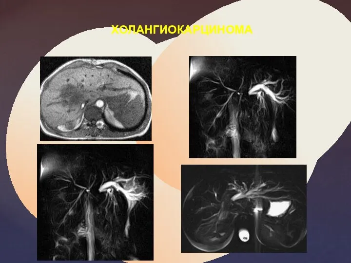 ХОЛАНГИОКАРЦИНОМА