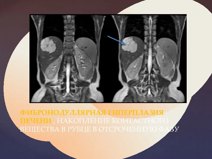 ФИБРОНОДУЛЛЯРНАЯ ГИПЕРПЛАЗИЯ ПЕЧЕНИ , НАКОПЛЕНИЕ КОНТАСТНОГО ВЕЩЕСТВА В РУБЦЕ В ОТСРОЧЕННУЮ ФАЗУ