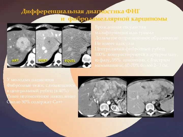 Дифференциальная диагностика ФНГ и фиброламеллярной карциномы Врожденная сосудистая мальформация или травма