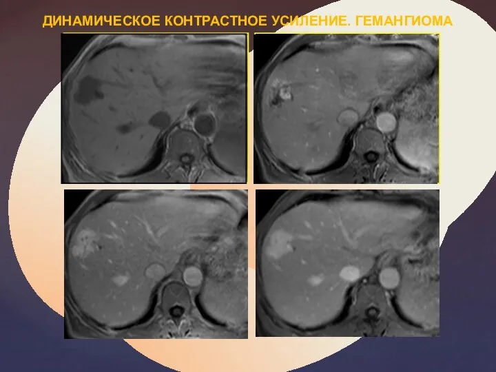 ДИНАМИЧЕСКОЕ КОНТРАСТНОЕ УСИЛЕНИЕ. ГЕМАНГИОМА ‏