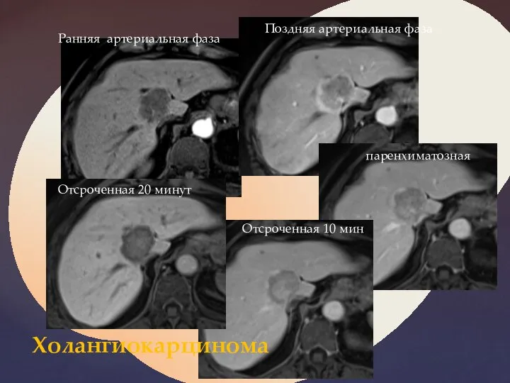 Ранняя артериальная фаза Поздняя артериальная фаза паренхиматозная Отсроченная 10 мин Отсроченная 20 минут Холангиокарцинома