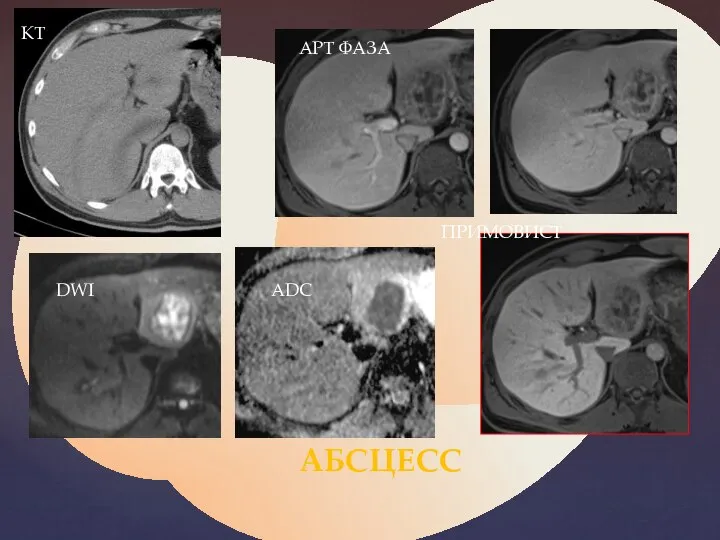 КТ DWI ADC ПРИМОВИСТ АРТ ФАЗА АБСЦЕСС