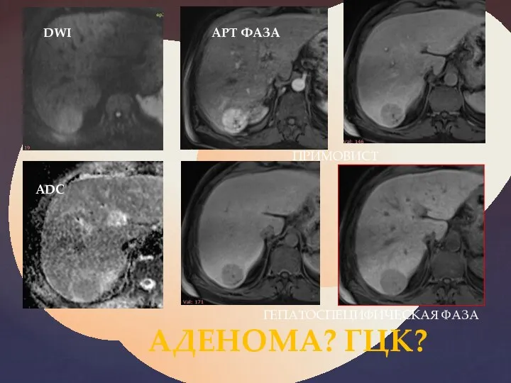 DWI ADC AРТ ФАЗА ПРИМОВИСТ ГЕПАТОСПЕЦИФИЧЕСКАЯ ФАЗА АДЕНОМА? ГЦК?