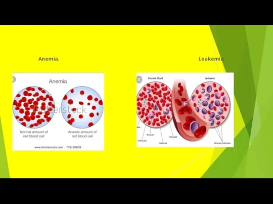 Anemia. Leukemia