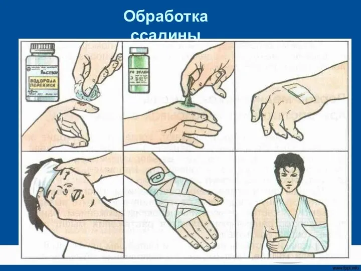 Обработка ссадины