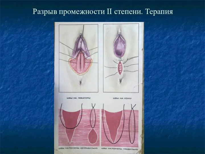 Разрыв промежности II степени. Терапия