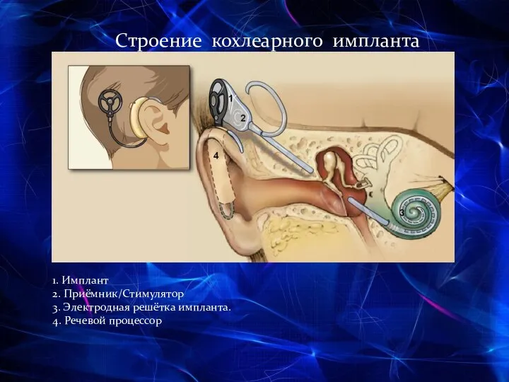 Строение кохлеарного импланта 1. Имплант 2. Приёмник/Стимулятор 3. Электродная решётка импланта. 4. Речевой процессор