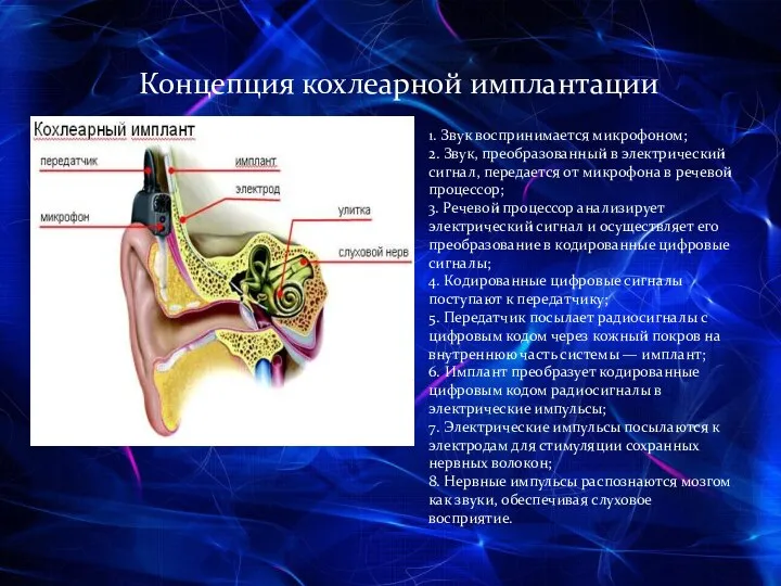 Концепция кохлеарной имплантации 1. Звук воспринимается микрофоном; 2. Звук, преобразованный в