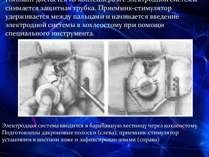 Имплант достается из контейнера и с электродной системы снимается защитная трубка.