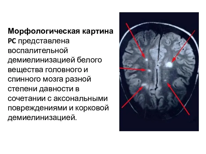 Морфологическая картина PC представлена воспалительной демиелинизацией белого вещества головного и спинного