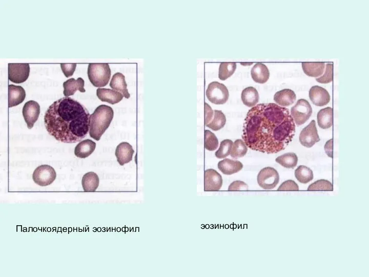 Палочкоядерный эозинофил эозинофил