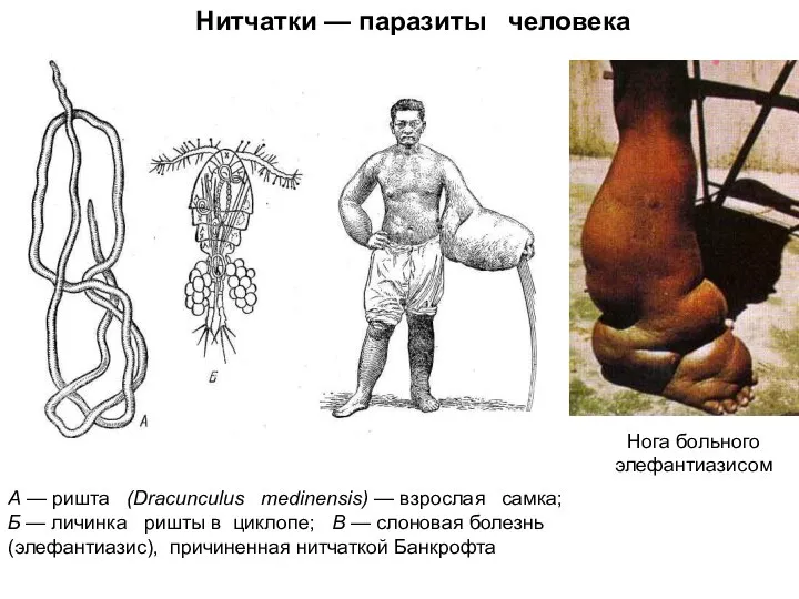 Нитчатки — паразиты человека А — ришта (Dracunculus medinensis) — взрослая