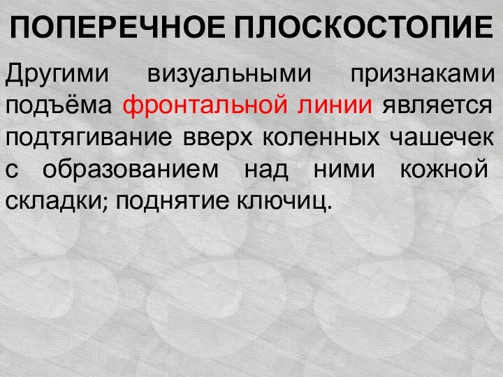 ПОПЕРЕЧНОЕ ПЛОСКОСТОПИЕ Другими визуальными признаками подъёма фронтальной линии является подтягивание вверх