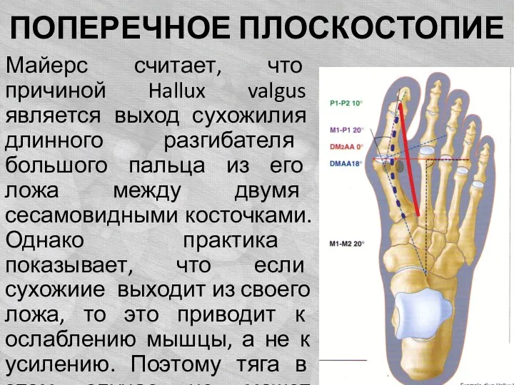 ПОПЕРЕЧНОЕ ПЛОСКОСТОПИЕ Майерс считает, что причиной Hallux valgus является выход сухожилия