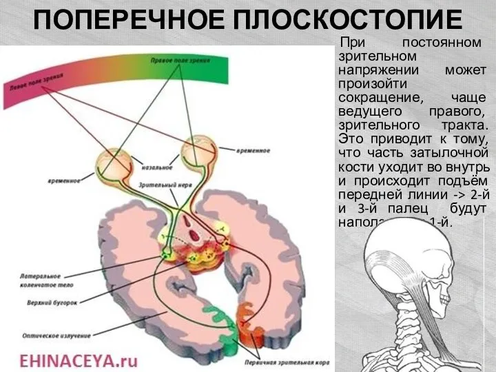 ПОПЕРЕЧНОЕ ПЛОСКОСТОПИЕ При постоянном зрительном напряжении может произойти сокращение, чаще ведущего