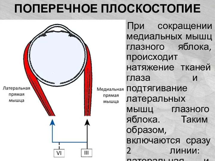 ПОПЕРЕЧНОЕ ПЛОСКОСТОПИЕ При сокращении медиальных мышц глазного яблока, происходит натяжение тканей