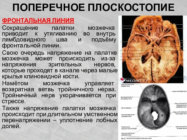 ПОПЕРЕЧНОЕ ПЛОСКОСТОПИЕ ФРОНТАЛЬНАЯ ЛИНИЯ Сокращение палатки мозжечка приводит к утягиванию во