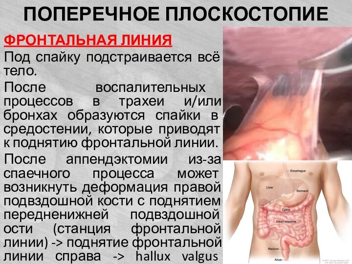 ПОПЕРЕЧНОЕ ПЛОСКОСТОПИЕ ФРОНТАЛЬНАЯ ЛИНИЯ Под спайку подстраивается всё тело. После воспалительных