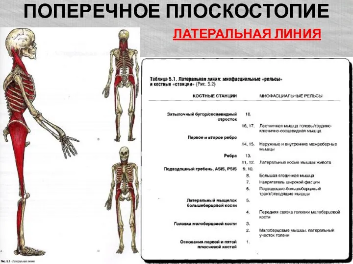 ПОПЕРЕЧНОЕ ПЛОСКОСТОПИЕ ЛАТЕРАЛЬНАЯ ЛИНИЯ