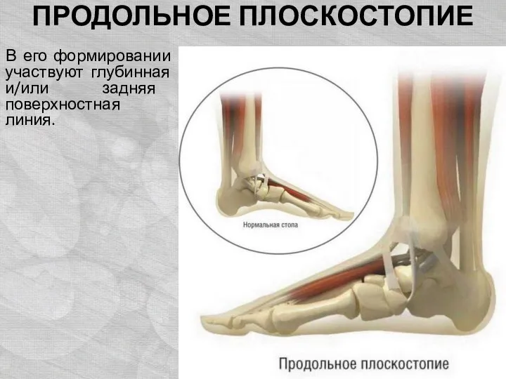 ПРОДОЛЬНОЕ ПЛОСКОСТОПИЕ В его формировании участвуют глубинная и/или задняя поверхностная линия.