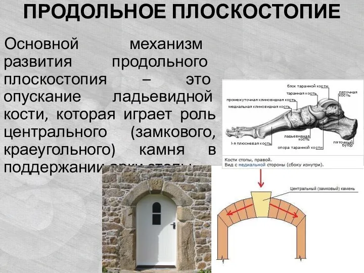 ПРОДОЛЬНОЕ ПЛОСКОСТОПИЕ Основной механизм развития продольного плоскостопия – это опускание ладьевидной