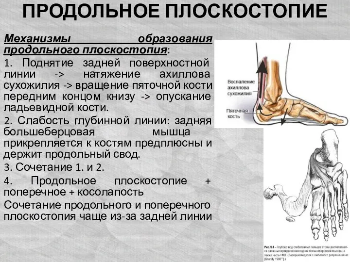 ПРОДОЛЬНОЕ ПЛОСКОСТОПИЕ Механизмы образования продольного плоскостопия: 1. Поднятие задней поверхностной линии