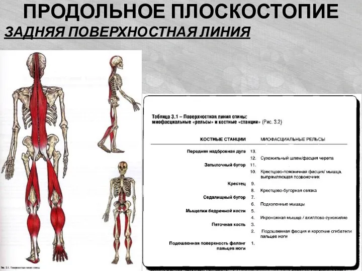 ПРОДОЛЬНОЕ ПЛОСКОСТОПИЕ ЗАДНЯЯ ПОВЕРХНОСТНАЯ ЛИНИЯ