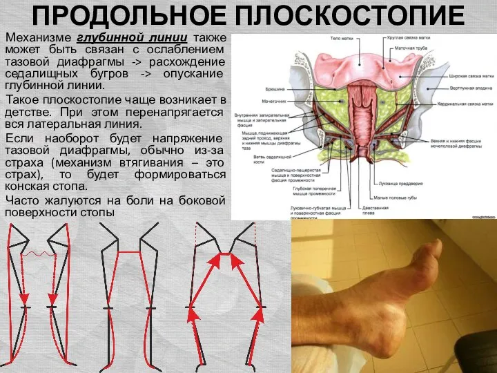 ПРОДОЛЬНОЕ ПЛОСКОСТОПИЕ Механизме глубинной линии также может быть связан с ослаблением