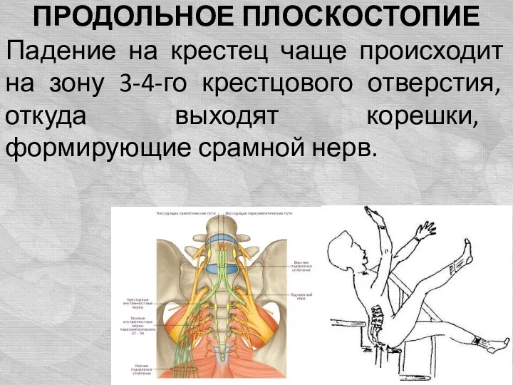 ПРОДОЛЬНОЕ ПЛОСКОСТОПИЕ Падение на крестец чаще происходит на зону 3-4-го крестцового