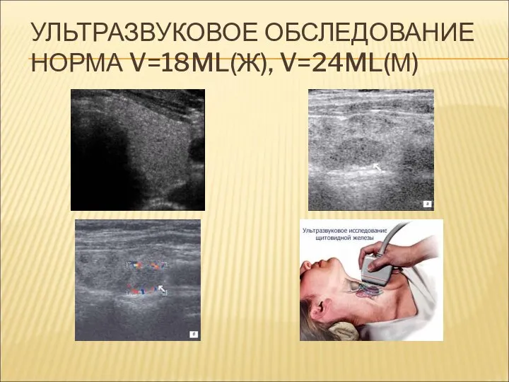 УЛЬТРАЗВУКОВОЕ ОБСЛЕДОВАНИЕ НОРМА V=18ML(Ж), V=24ML(М)