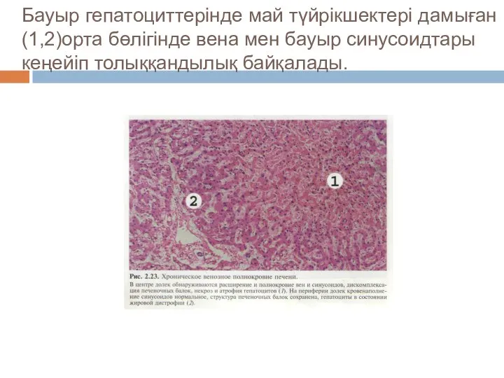 Бауыр гепатоциттерінде май түйрікшектері дамыған(1,2)орта бөлігінде вена мен бауыр синусоидтары кеңейіп толыққандылық байқалады.