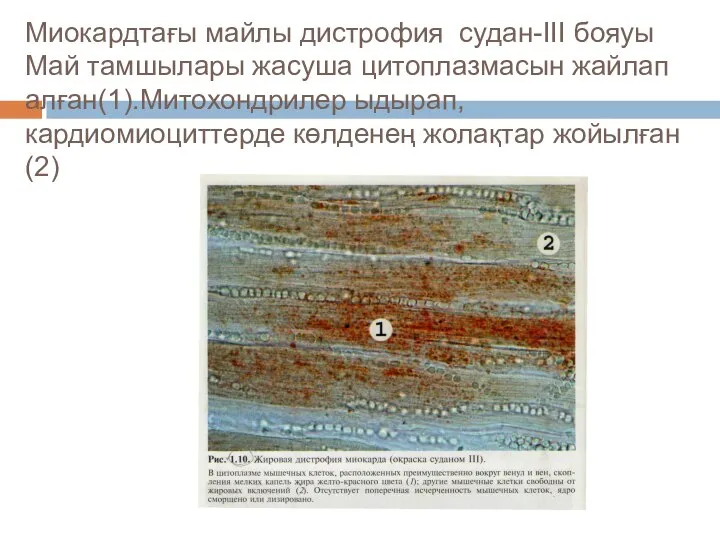 Миокардтағы майлы дистрофия судан-ΙΙΙ бояуы Май тамшылары жасуша цитоплазмасын жайлап алған(1).Митохондрилер ыдырап,кардиомиоциттерде көлденең жолақтар жойылған(2)