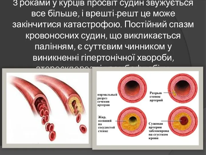 З роками у курців просвіт судин звужується все більше, і врешті-решт