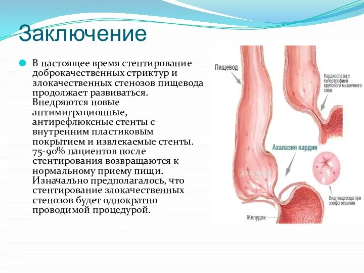 Заключение В настоящее время стентирование доброкачественных стриктур и злокачественных стенозов пищевода