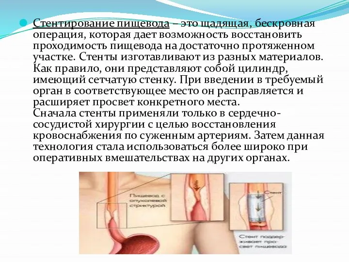 Стентирование пищевода – это щадящая, бескровная операция, которая дает возможность восстановить