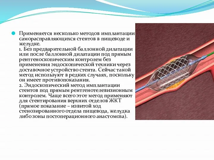 Методики стентирования пищевода и желудка Применяется несколько методов имплантации саморасправляющихся стентов