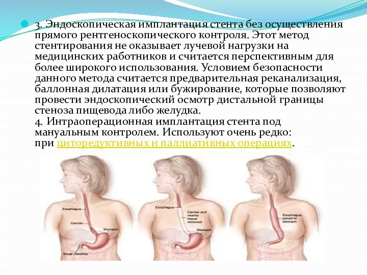 3. Эндоскопическая имплантация стента без осуществления прямого рентгеноскопического контроля. Этот метод