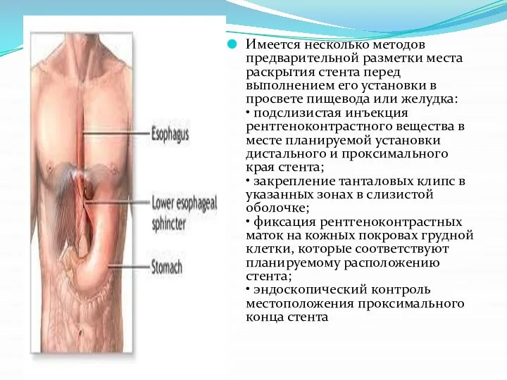 Имеется несколько методов предварительной разметки места раскрытия стента перед выполнением его