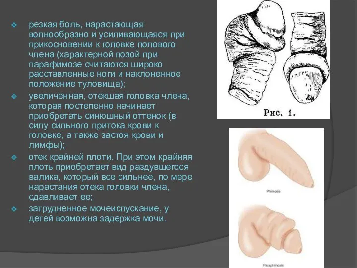 резкая боль, нарастающая волнообразно и усиливающаяся при прикосновении к головке полового