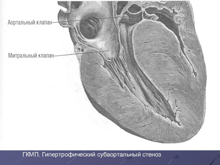 ГКМП. Гипертрофический субаортальный стеноз