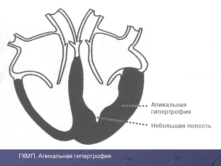 ГКМП. Апикальная гипертрофия