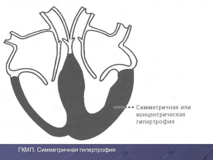 ГКМП. Симметричная гипертрофия