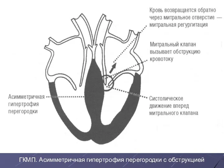 ГКМП. Асимметричная гипертрофия перегородки с обструкцией