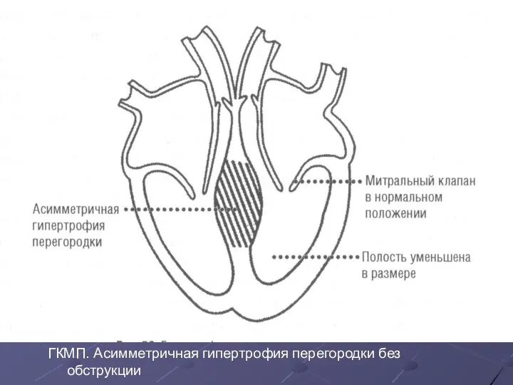 ГКМП. Асимметричная гипертрофия перегородки без обструкции