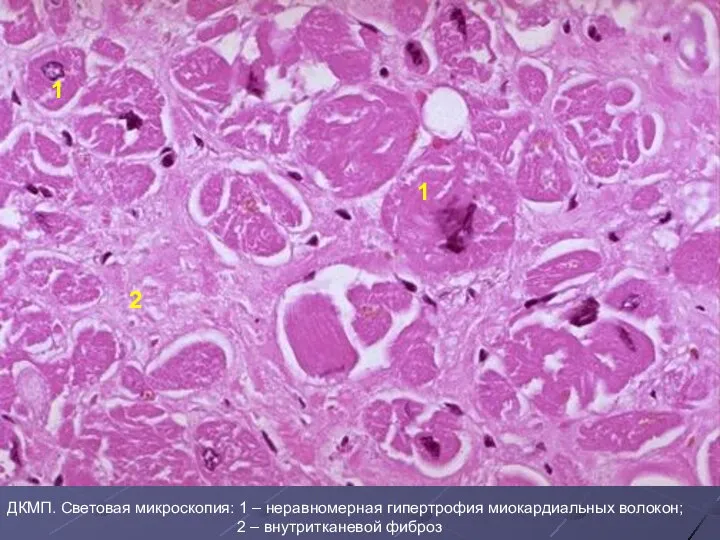 1 1 2 ДКМП. Световая микроскопия: 1 – неравномерная гипертрофия миокардиальных волокон; 2 – внутритканевой фиброз